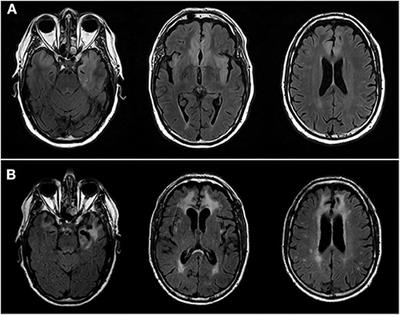 Two Cases of Late-Onset Anti-NMDAr Auto-Immune Encephalitis After Herpes Simplex Virus 1 Encephalitis